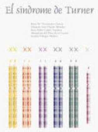 EL SÍNDROME DE TURNER