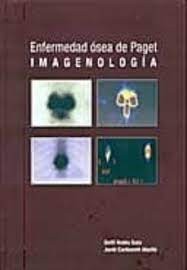 Enfermedad ósea de Paget