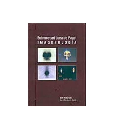 Enfermedad ósea de Paget